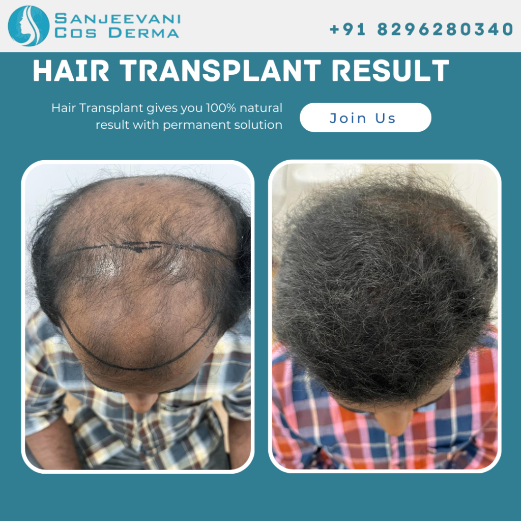 Hair Transplant Before & After